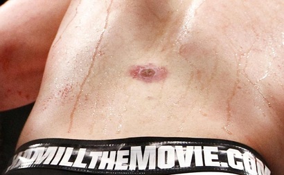 matt hamill gronkowiec